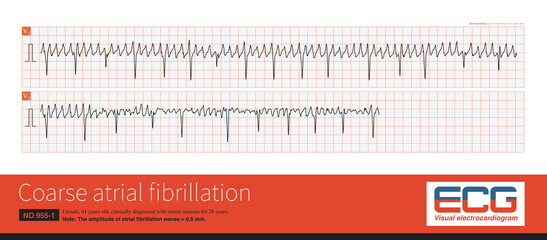 Sometimes, atrial fibrillation waves are very tall, resembling atrial flutter, and prolonged recordings will observe changes in the shape, frequency, and amplitude of the atrial depolarization waves.