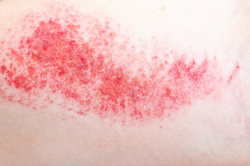 Children's hand burn. Children's hand with a burnt wound on a white background.Close up