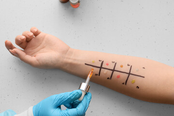 Doctor with dropper making allergy skin test on patient's hand in clinic, closeup - obrazy, fototapety, plakaty