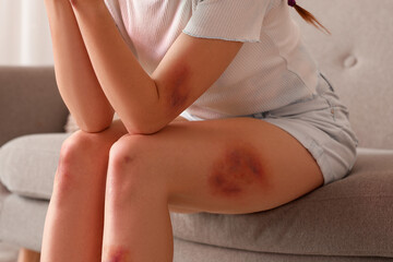 Young woman with bruises sitting on sofa at home, closeup