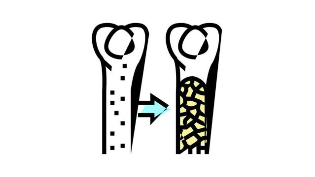 osteoporosis bone disease color icon animation