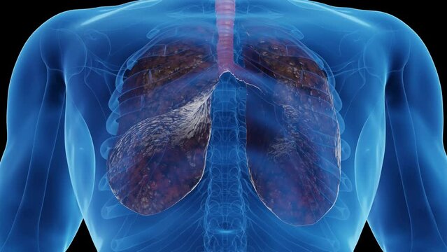 3d rendered medical animation of a smoker's lungs