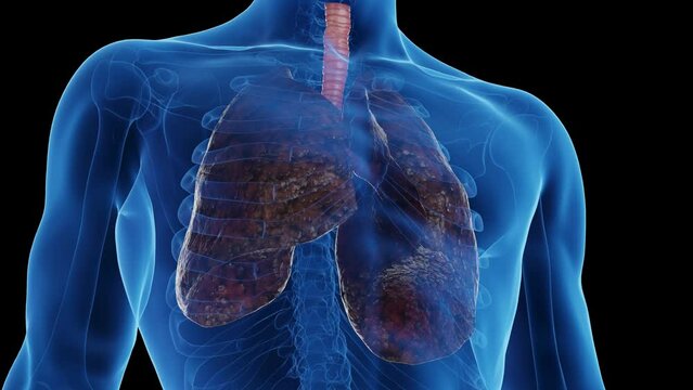 3d rendered medical animation of a smoker's lungs