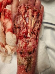 Necrotizing soft tissue infection right hand after debridement