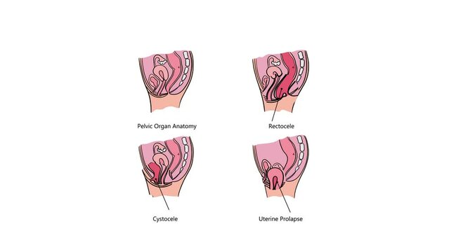 PELVIC ORGAN PROLAPSE VARIOUSLY VIDEO General Diagram With Explanatory Text And An Increase In Affected Area For Medical Education Anatomy Human Moving Banner