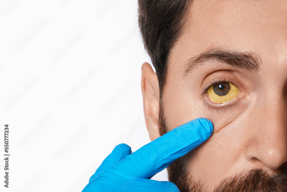 Poster Doctor checking man with yellow eyes on white background, closeup. Symptom of hepatitis