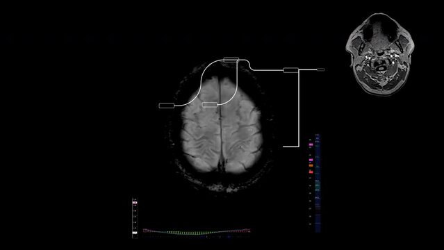 Computer screen with Brain MRI scans and diagnostic hi-tech data