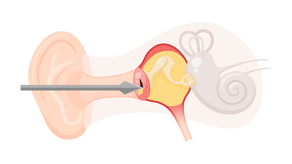 急性中耳炎の鼓膜切開のイラスト