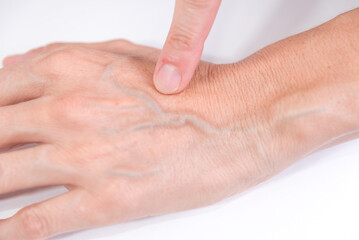 Fototapeta premium venous hand, blood, health care