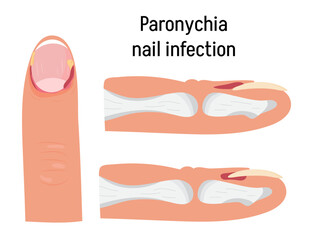 Paronychia concepnt vector for medical blog, app, banner. Nail inflammation that may result from trauma, irritation or infection.