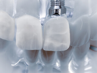 Close up of dentistry practise teeth