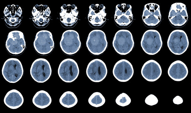 CT Brain Axial scans hyperdense mass with homogeneous, and mild perilesional brain edema at the right front-temporal-parietal region, Meningioma is suspected. Medical image concept.