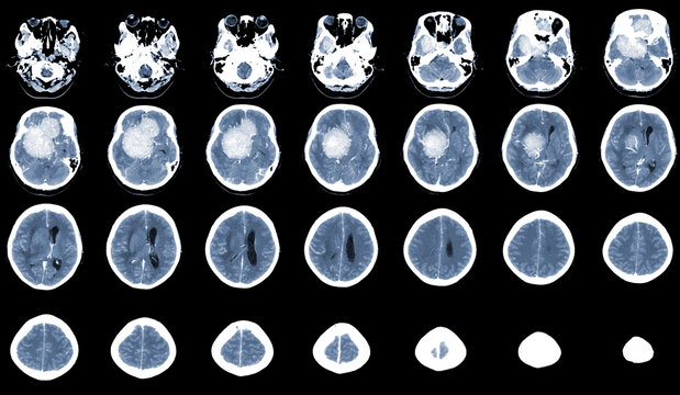 CT Brain Axial scans hyperdense mass with homogeneous, and mild perilesional brain edema at the right front-temporal-parietal region, Meningioma is suspected. Medical image concept.