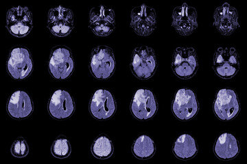 MRI Brain Axial views .to evaluate brain tumor. Glioblastoma, brain metastasis isodensity mass with an ill-defined margin and surrounding edema at the right frontal lobe. - obrazy, fototapety, plakaty