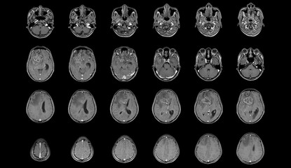 MRI Brain Axial views .to evaluate brain tumor. Glioblastoma, brain metastasis isodensity mass with...