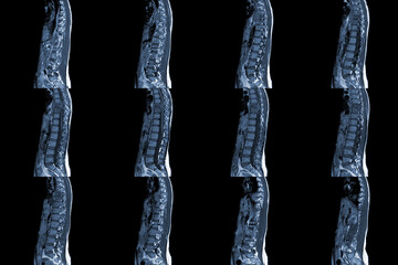 MRI of thoracic spine sagittal History of back pain with compression fracture of T9 Medical and...
