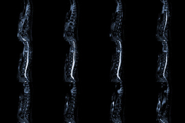 MRI of thoracic spine sagittal History of back pain with compression fracture of T9 Medical and...