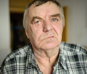 Aged man with facial nerve paralysis, Bell's palsy.