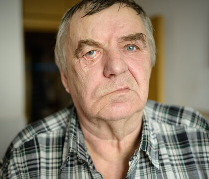 Aged Man With Facial Nerve Paralysis, Bell's Palsy.