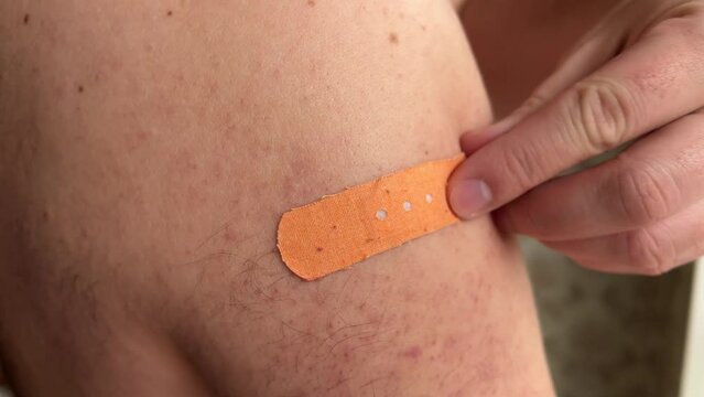 White man removes band-aid from his injured arm. Bad painful skin with pimples and acne. Man was vaccinated against covid-19. Plaster marks on shoulder. Concept of disease, treatment, recovery. Virus