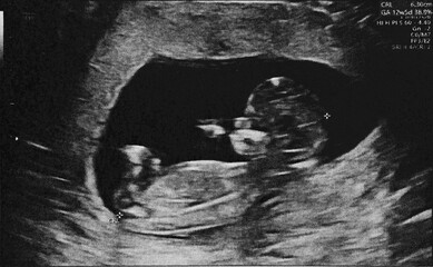 Pregnant baby infant ultrasound display. Mother belly screen in hospital. Womb scan