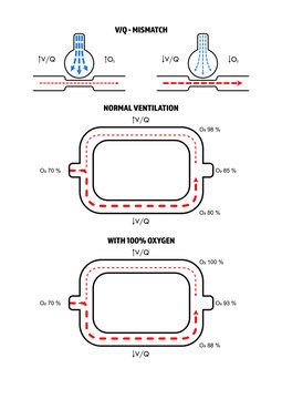 VQ Mismatch - Ventilation Perfusion Mismatch and Ratio
