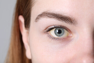 Woman with yellow eyes on light background, closeup. Symptom of hepatitis