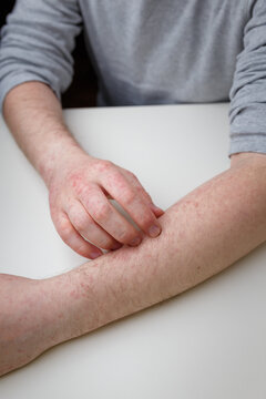man scratching his arm with red itchy rash, allegry, dermatitis or other skin illness with painful symptoms. Dermatology and skin health care