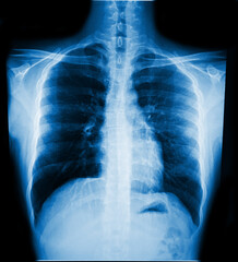 X-Ray Image Of Human Chest for a medical diagnosis