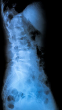 X-Ray spine of patient