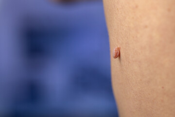 Fototapeta premium Close-up of large rashes or smallpox on the skin of an adult male. Pigmented spots on the back of a man. Skin of a man with moles. Acne.