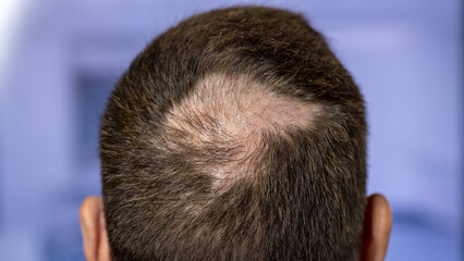 Obraz premium Man with hair loss problems closeup, isolated. Alopecia balding hairs on man scalp. Human alopecia or hair loss - person hand pointing his bald head. Scratching his head. Baldness. Depression, stress