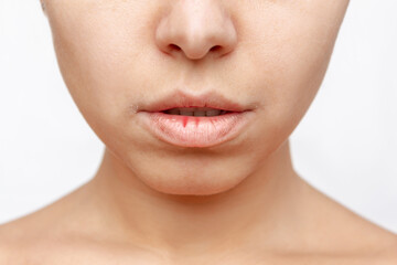 Cropped shot of a young caucasian woman with dry cracked lips from frost or vitamin deficiency isolated on a white background. Flaky, weathered lips - obrazy, fototapety, plakaty