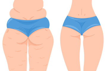 Color vector illustration before and after losing weight. Female back view with and without cellulite. Female buttocks in a blue panties