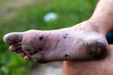 human heel.dirty foot of a homeless person