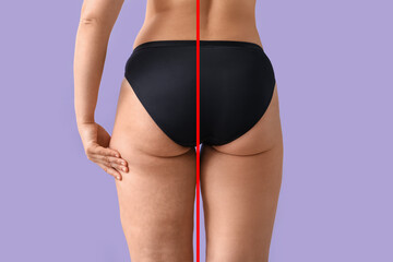 Young woman before and after anti cellulite treatment on lilac background, top view - obrazy, fototapety, plakaty