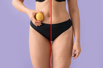 Young woman before and after anti cellulite treatment on lilac background - obrazy, fototapety, plakaty