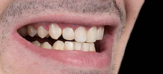 dental photography picture of dental treatment case