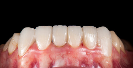 Fototapeta na wymiar dental photography picture of dental treatment case