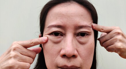 portrait the fingers holding the flabbiness adipose sagging skin beside the eyelid, cellulite and...