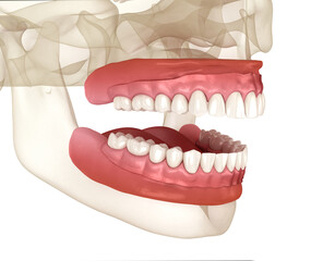 Removable prosthesis, artificial gum and teeth. Dental 3D illustration