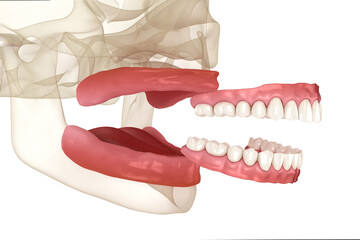 Removable prosthesis, artificial gum and teeth. Dental 3D illustration
