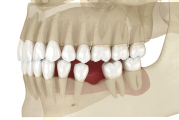 Teeth shift deformatiuon after losing molar tooth. 3D illustration of Popov Godon phenomenon