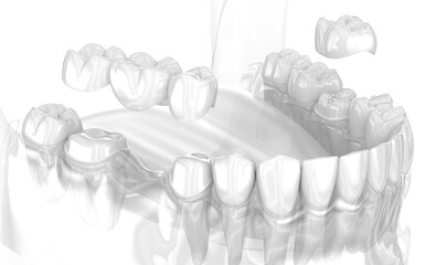 Dental ceramic crown and dental bridge placement. Medically accurate 3D illustration