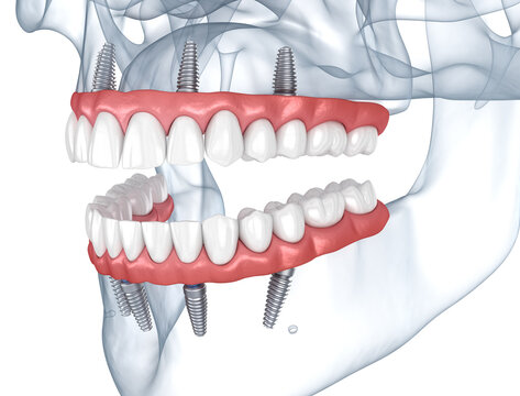 Prostheses supported by 8 implants. Dental 3D illustration