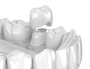 Dental ceramic crown placement. Medically accurate 3D illustration