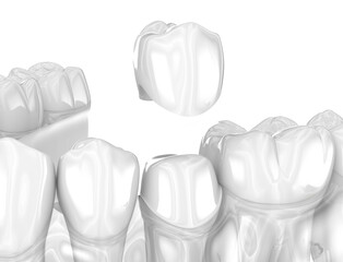 Dental ceramic crown placement. Medically accurate 3D illustration