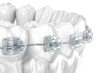 Dental braces and teeth. 3D illustration