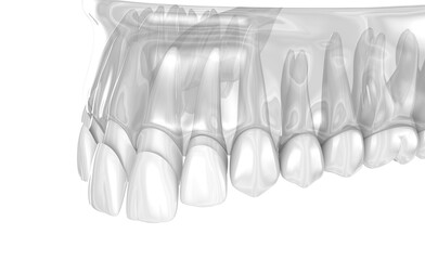 Veneer installation placement over central and lateral incisor. Medically accurate tooth 3D illustration