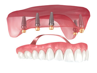 Removable prosthesis based on six implants. Dental 3D illustration